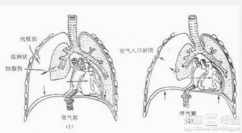 气胸是一种什么病